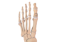 【Ososi Aktar セット】 Arthrex - Small Staple, 10 mm, SS - AR-8710